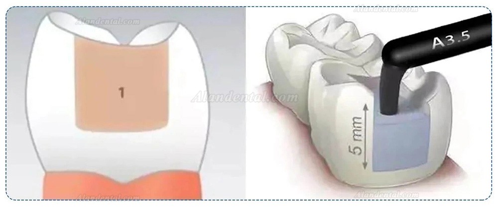 10 Capsule/Box A1/A2/A3/A3.5 Dental Composite Resin Light Cure Capsule